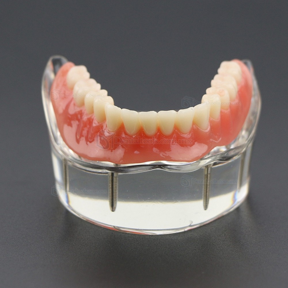 Dental Inferiores Modelo de Implante de sobredentadura 4 Implantes Demostración Modelo 6002 02